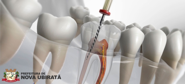 Saúde bucal: Projeto ‘Sorria Nova Ubiratã’ ganha opção de tratamento para canal dentário